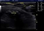 Thymus
